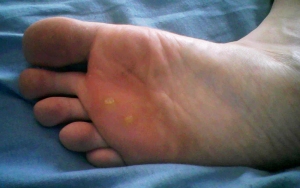 Plantar Warts after two weeks of lemon oil treatment